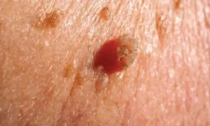 Thiếu nữ 28 tuổi bị sùi mào gà sau quan hệ tình dục