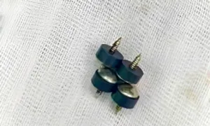 Bé 2 tuổi nuốt 4 đinh nam châm